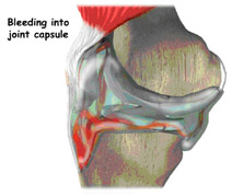 bleeding into joint capsule,acl injury,acl reconstruction india,acl reconstruction best india,acl reconstructionbest doctors in india,acl reconstruction best surgeon in india,acl reconstructionbest surgery in india,acl reconstruction best treatment in  india,acl reconstruction in south  india,acl reconstruction north  india,acl reconstruction  east india,acl reconstruction west india,acl reconstruction best in  india,acl reconstruction best surgery in india,acl reconstruction cost-effective in  india,acl reconstruction best doctors in india,acl reconstruction india,acl reconstruction india,acl reconstruction india,acl reconstruction now in india,acl reconstruction india,acl reconstruction by dr.bajaj,acl reconstruction by p.s.bajaj