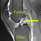 femur,acl injury,acl reconstruction india,acl reconstruction best india,acl reconstructionbest doctors in india,acl reconstruction best surgeon in india,acl reconstructionbest surgery in india,acl reconstruction best treatment in  india,acl reconstruction in south  india,acl reconstruction north  india,acl reconstruction  east india,acl reconstruction west india,acl reconstruction best in  india,acl reconstruction best surgery in india,acl reconstruction cost-effective in  india,acl reconstruction best doctors in india,acl reconstruction india,acl reconstruction india,acl reconstruction india,acl reconstruction now in india,acl reconstruction india,acl reconstruction by dr.bajaj,acl reconstruction by p.s.bajaj