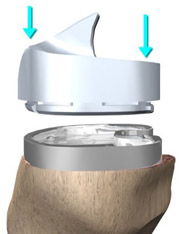 tibia components,knee replacement india,south delhi ,knee replacement india,knee replacement in india,knee replacement in south delhi,knee replacement, knee replacement in delhi,knee replacement surgeon india,knee replacement clinic india,knee replacement doctor india,knee replacement doctor delhi,knee replacement surgeon in south-ex delhi,knee replacement in east delhi, knee replacement, knee replacement india ,knee replacement delhi , knee replacement ,knee replacement india, knee replacement south delhi, knee replacement,knee replacement india,south delhi ,knee replacement india,knee replacement in india,knee replacement in south delhi,knee replacement, knee replacement in delhi,knee replacement surgeon india,knee replacement clinic india,knee replacement doctor india,knee replacement doctor delhi,knee replacement surgeon in south-ex delhi,knee replacement in east delhi, knee replacement, knee replacement india ,knee replacement delhi , knee replacement ,knee replacement india, knee replacement south delhi