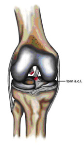 acl injury,acl reconstruction india,acl reconstruction best india,acl reconstructionbest doctors in india,acl reconstruction best surgeon in india,acl reconstructionbest surgery in india,acl reconstruction best treatment in  india,acl reconstruction in south  india,acl reconstruction north  india,acl reconstruction  east india,acl reconstruction west india,acl reconstruction best in  india,acl reconstruction best surgery in india,acl reconstruction cost-effective in  india,acl reconstruction best doctors in india,acl reconstruction india,acl reconstruction india,acl reconstruction india,acl reconstruction now in india,acl reconstruction india,acl reconstruction by dr.bajaj,acl reconstruction by p.s.bajaj