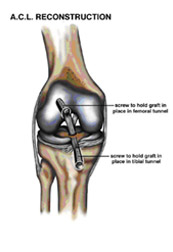 acl reconstruction,acl injury,acl reconstruction india,acl reconstruction best india,acl reconstructionbest doctors in india,acl reconstruction best surgeon in india,acl reconstructionbest surgery in india,acl reconstruction best treatment in  india,acl reconstruction in south  india,acl reconstruction north  india,acl reconstruction  east india,acl reconstruction west india,acl reconstruction best in  india,acl reconstruction best surgery in india,acl reconstruction cost-effective in  india,acl reconstruction best doctors in india,acl reconstruction india,acl reconstruction india,acl reconstruction india,acl reconstruction now in india,acl reconstruction india,acl reconstruction by dr.bajaj,acl reconstruction by p.s.bajaj