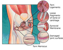 arthroscopy in india ,arthroscopy in delhi,arthroscopy india