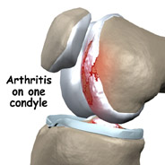 unicompartment damage,knee replacement india,south delhi ,knee replacement india,knee replacement in india,knee replacement in south delhi,knee replacement, knee replacement in delhi,knee replacement surgeon india,knee replacement clinic india,knee replacement doctor india,knee replacement doctor delhi,knee replacement surgeon in south-ex delhi,knee replacement in east delhi, knee replacement, knee replacement india ,knee replacement delhi , knee replacement ,knee replacement india, knee replacement south delhi, knee replacement,india